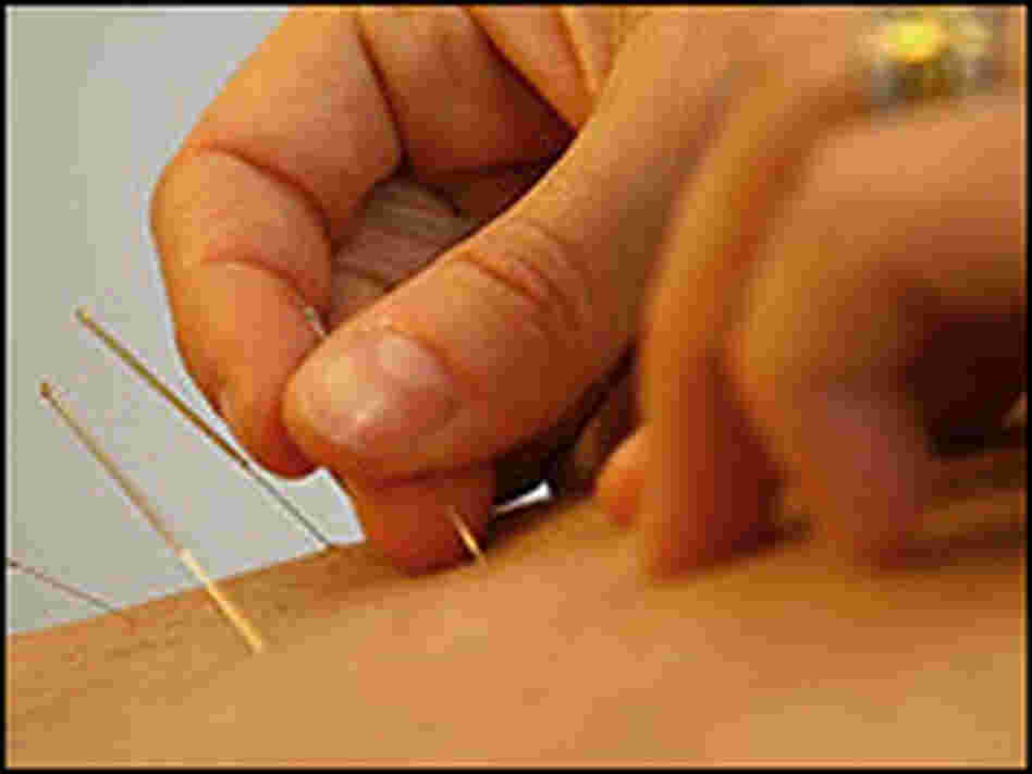 An acupuncturist inserts needles into a patient's back.