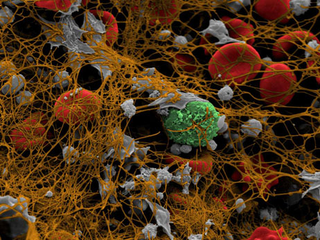 portrait of a blood clot: electron micrograph of blood cells enmeshed in fibrin web