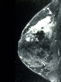 mri breast cancer