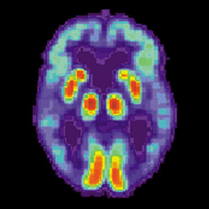 PET scan of an Alzheimer's brain.
