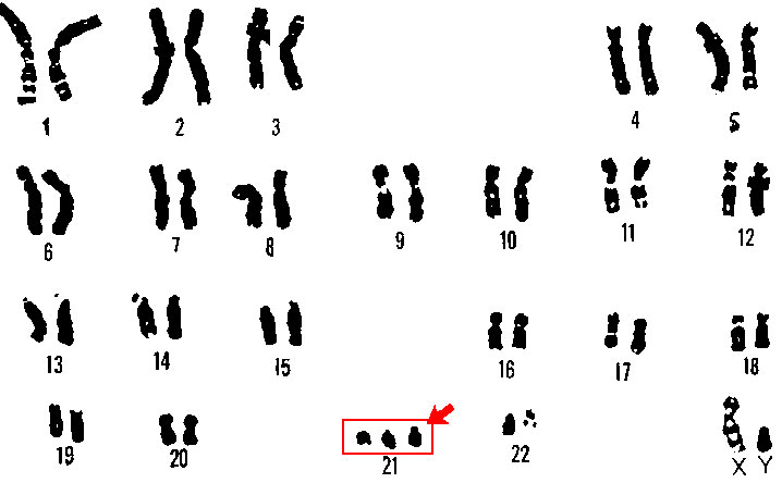 Karotype of a male with Down syndrome.