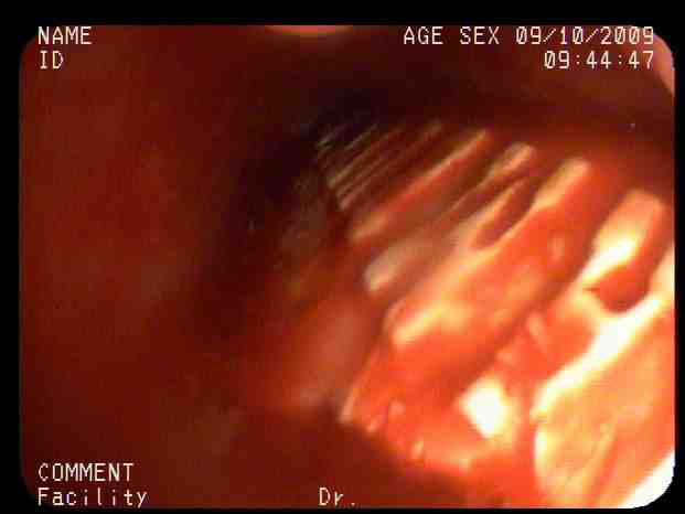 A fragment of a Wendy's utensil lodged in John Manley's lung.