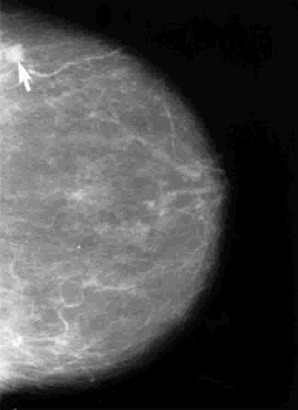 Breast cancer shows up on a mammogram. Breast cancer shows up on a mammogram.