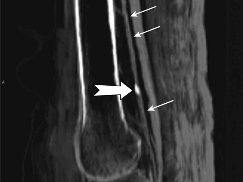 Big arrow points to calcification in a leg artery of a mummified Egyptian woman who lived in the 18t Big arrow points to calcification in a leg artery of a mummified Egyptian woman who lived in the 18t