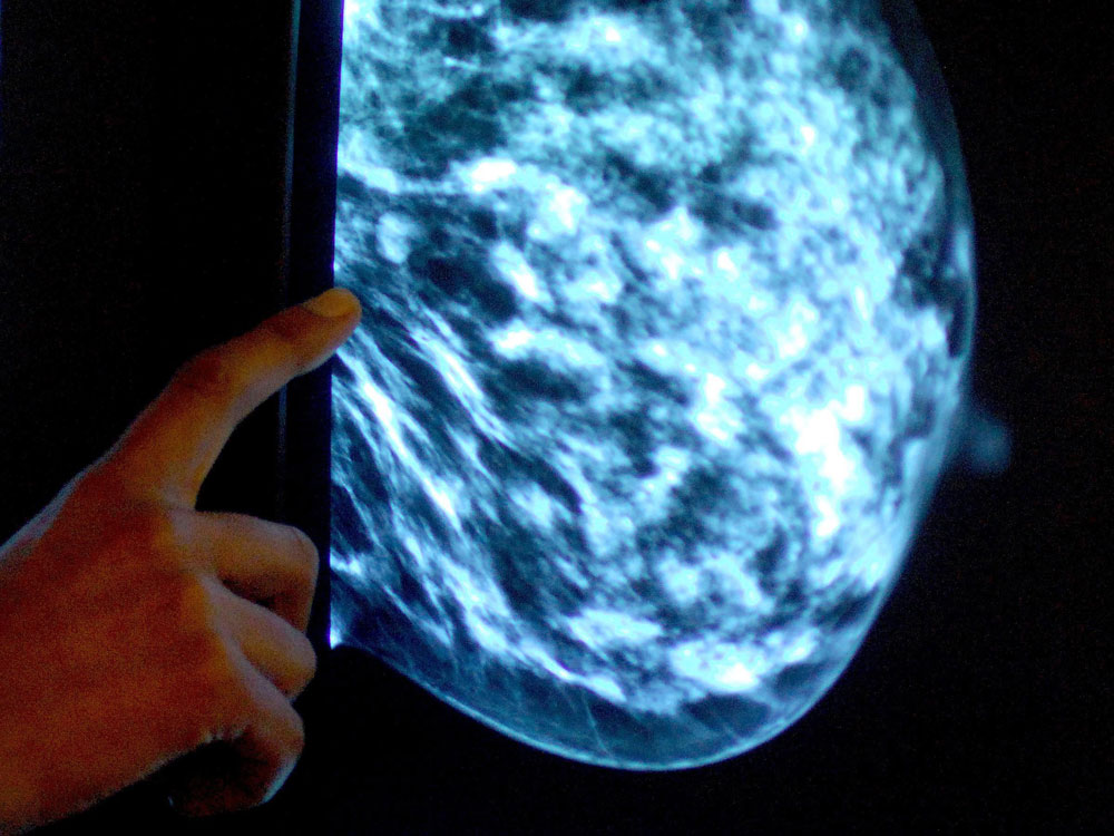 Mammogram.