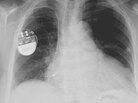 An implanted pacemaker. An implanted pacemaker.
