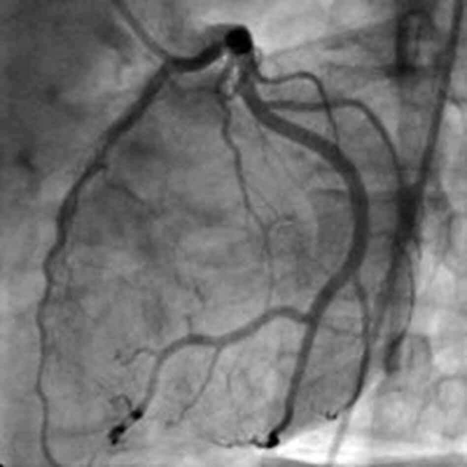 Angiograms may be used too often. Angiograms may be used too often.