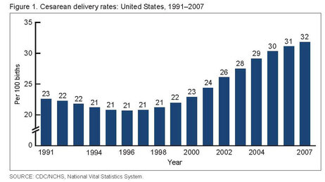C-sections have hit an new high in the U.S.