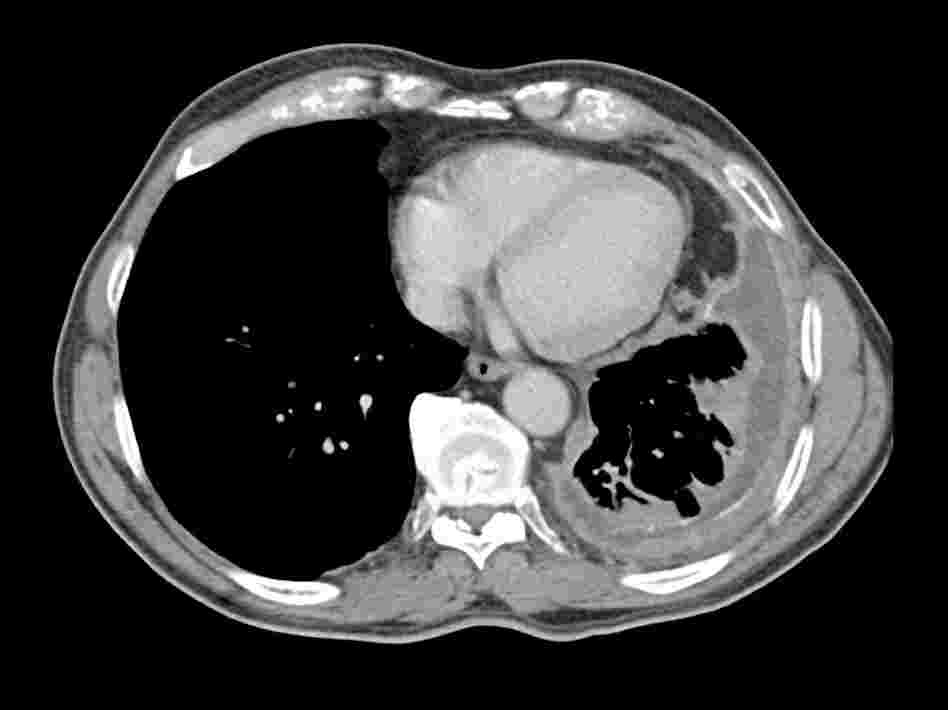 Lung+ct+scan+images