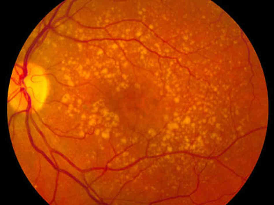 Intermediate age-related macular degeneration Intermediate age-related macular degeneration