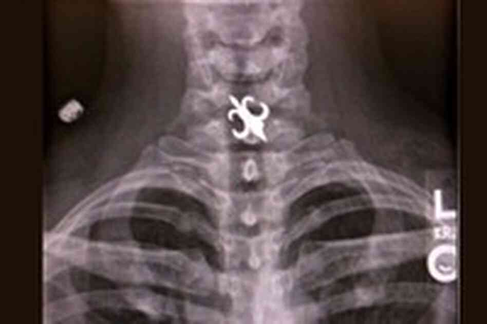 X-ray of woman who swallowed a Saints earring. X-ray of woman who swallowed a Saints earring.