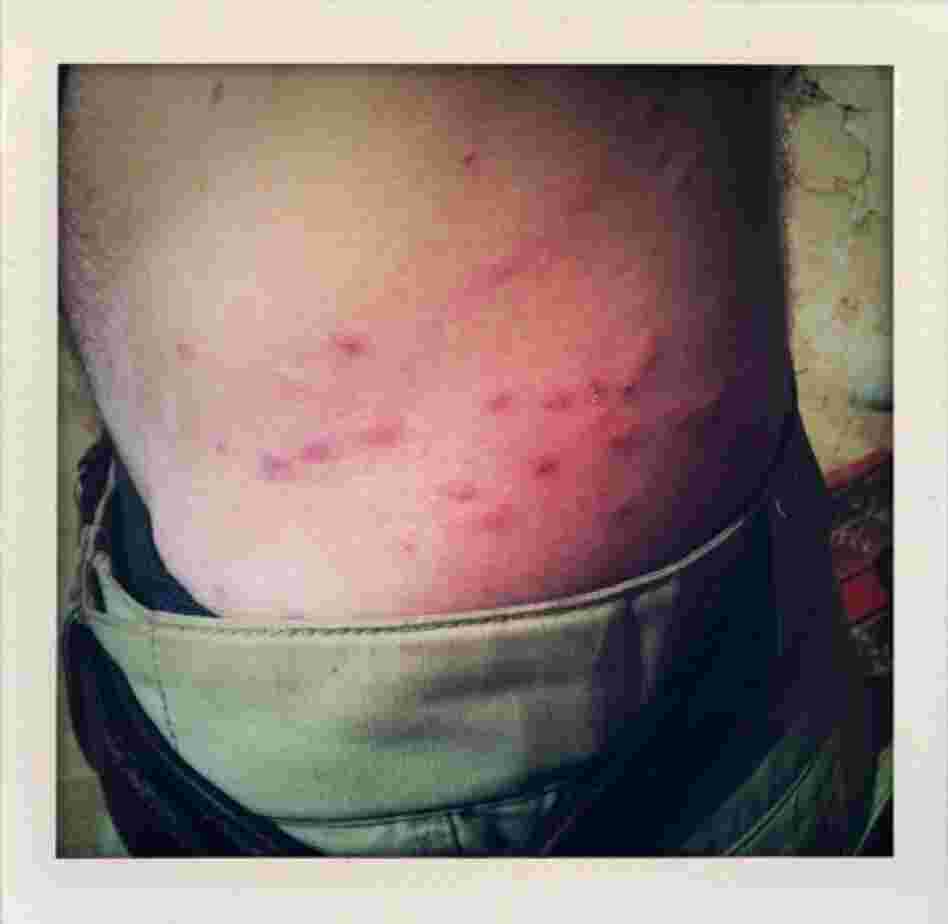 Flea bites cover the skin of a journalist in Marjah.