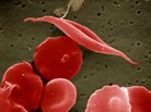 Sickle-cell and normal red blood cells Sickle-cell and normal red blood cells