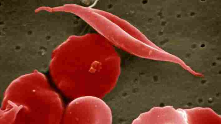 Sickle-cell and normal red blood cells