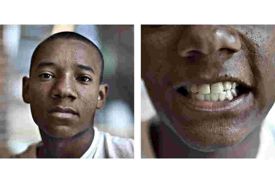 Ricardo Carter, 16, had braces in his early teens. Now he's wearing a clear, acrylic retainer to correct some shifting. Teeth are most prone to moving back to their original locations within the first five years after braces come off.