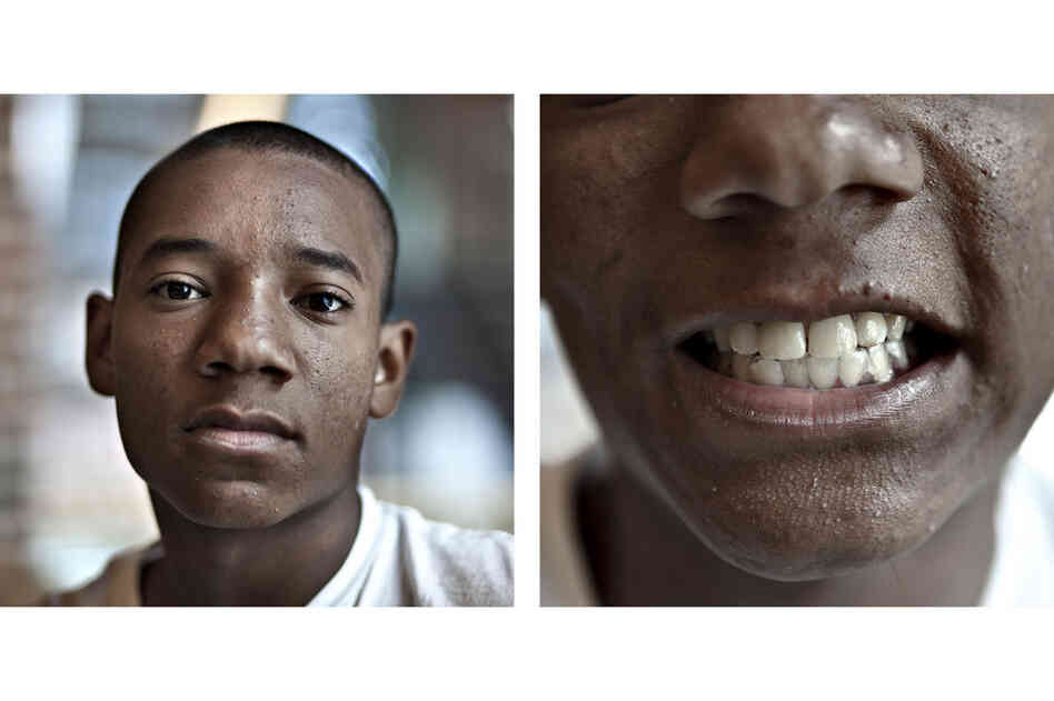 Ricardo Carter, 16, had braces in his early teens. Now he's wearing a clear, acrylic retainer to correct some shifting. Teeth are most prone to moving back to their original locations within the first five years after braces come off.
