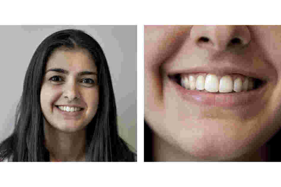 Dalia Shlash, an orthodontist-in-training, didn't wear a retainer after first having braces when she was 14.  She later had Invisalign treatment to correct the relapse. "Teeth always want to go back to the way they were initially," she says.