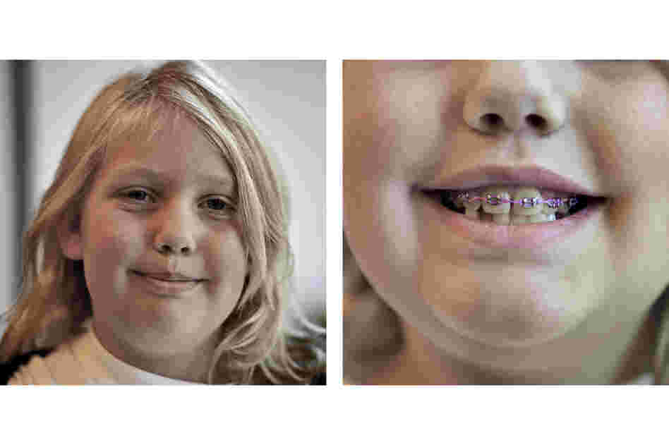 A crossbite led Rachel Bateman, 9, to a mouth full of braces. Williams, her orthodontist, decided not to give her an expander, a popular device that can sometimes lead to relapse.