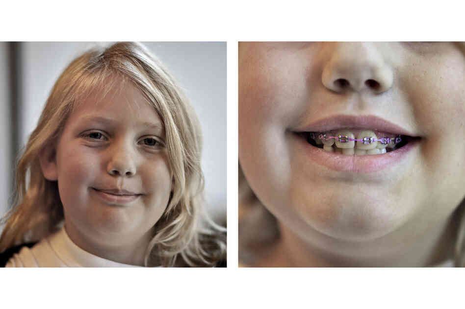 A crossbite led Rachel Bateman, 9, to a mouth full of braces. Williams, her orthodontist, decided not to give her an expander, a popular device that can sometimes lead to relapse.