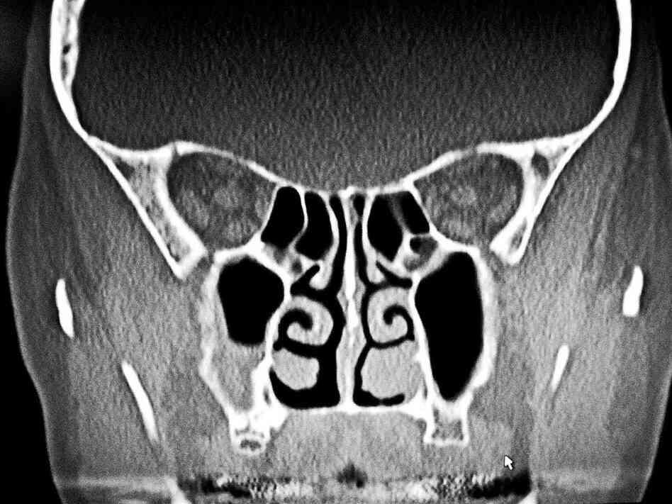 CAT scan of patient Judy Foreman's sinuses CAT scan of patient Judy Foreman's sinuses