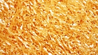 Treponema pallidum, the bacteria that cause syphilis.