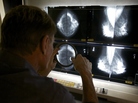 Mammograms Mammograms