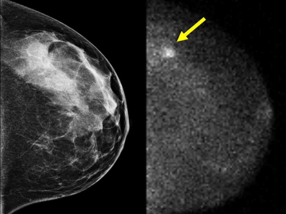 breast cancer spot breast cancer spot