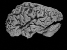 A brain shrunken by Alzheimer's A brain shrunken by Alzheimer's