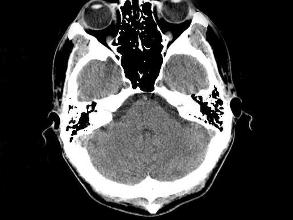 A CT scan of the brain A CT scan of the brain