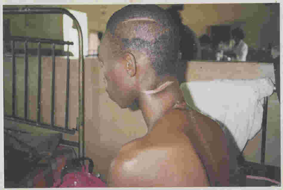 A man with three healing machete wounds on head and neck A man with three healing machete wounds on head and neck