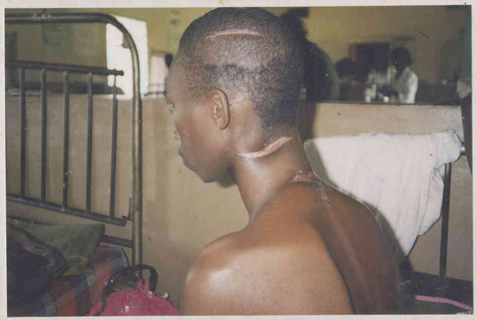 A man with three healing machete wounds on head and neck A man with three healing machete wounds on head and neck