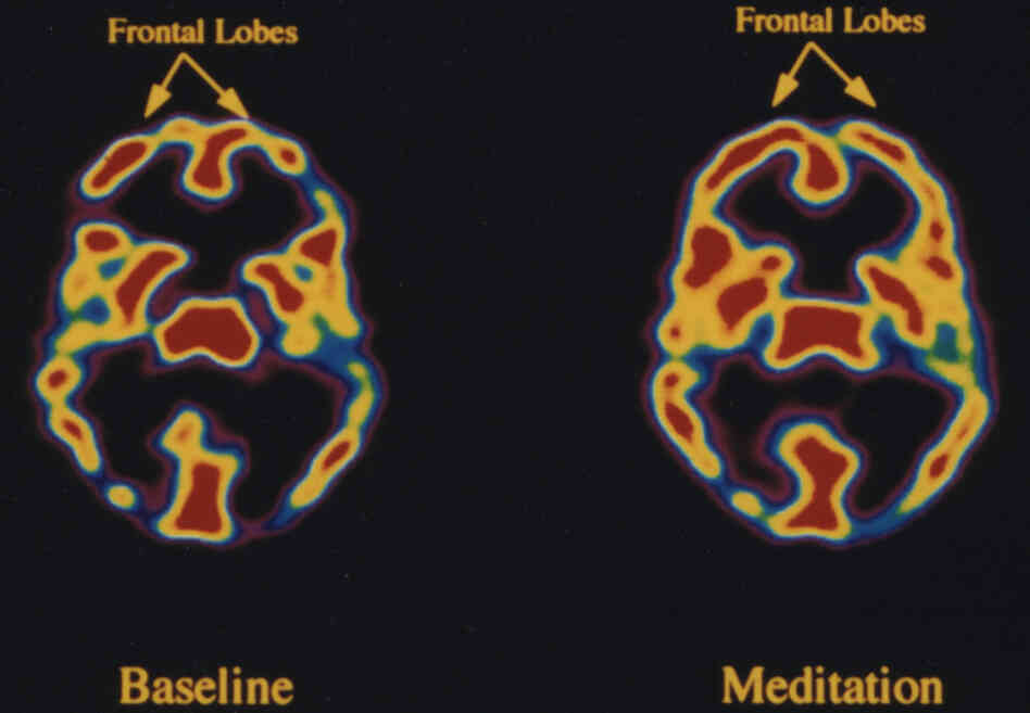 The effect of meditation on the brain activity in Tibetan meditators: frontal lobes The effect of meditation on the brain activity in Tibetan meditators: frontal lobes