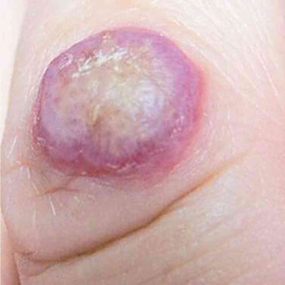 A virus caught from a deer caused this sore on a Virginia deer hunter's finger. A virus caught from a deer caused this sore on a Virginia deer hunter's finger.