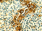Metastatic breast cancer cells found in a lymph node. Metastatic breast cancer cells found in a lymph node.
