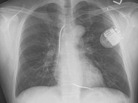 A normal chest X-ray after the implant of an cardioverter defibrillator. A normal chest X-ray after the implant of an cardioverter defibrillator.