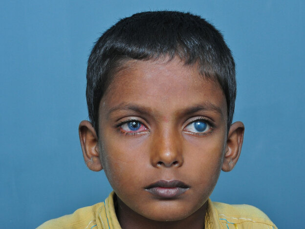The young patient's eyes after his cornea  transplant.