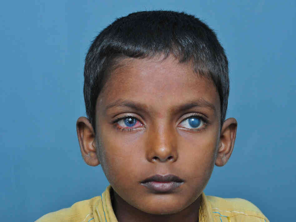 The young patient's eyes after his cornea  transplant.