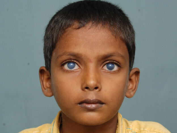 This young patient from India received his cornea transplant in 2009, when he was 10. Here he is shown before (above) and after (below) the transplant, which he received at the LV Prasad Eye Institute (LVPEI), SightLife's partner center in Hyderabad, India.