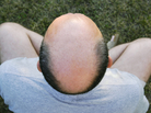 Researchers think early baldness may be a warning sign for prostate cancer. Researchers think early baldness may be a warning sign for prostate cancer.