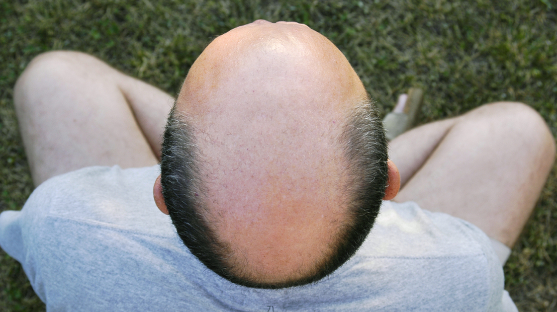 Researchers think early baldness may be a warning sign for prostate cancer.