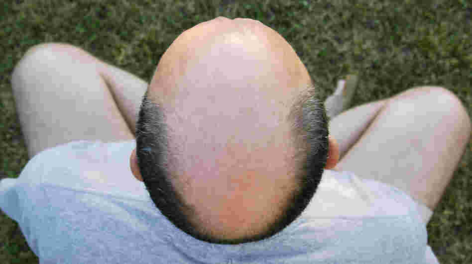 Researchers think early baldness may be a warning sign for prostate cancer.