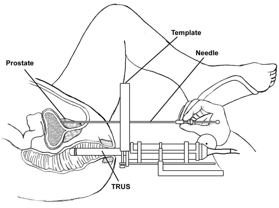 Brachytherapy for prostate cancer.