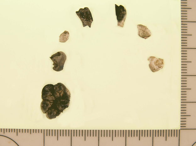 Teeth from a cremated child were excavated from a site believed to be 11,500 years old. The color differences show uneven burning. The scale is in millimeters.