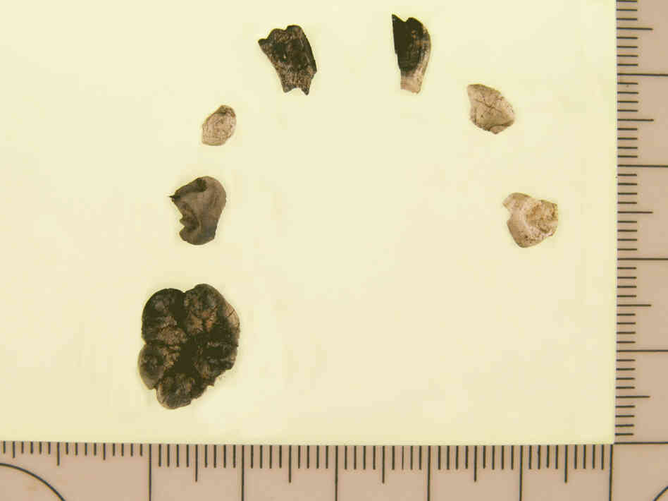Teeth from a cremated child were excavated from a site believed to be 11,500 years old. The color differences show uneven burning. The scale is in millimeters.