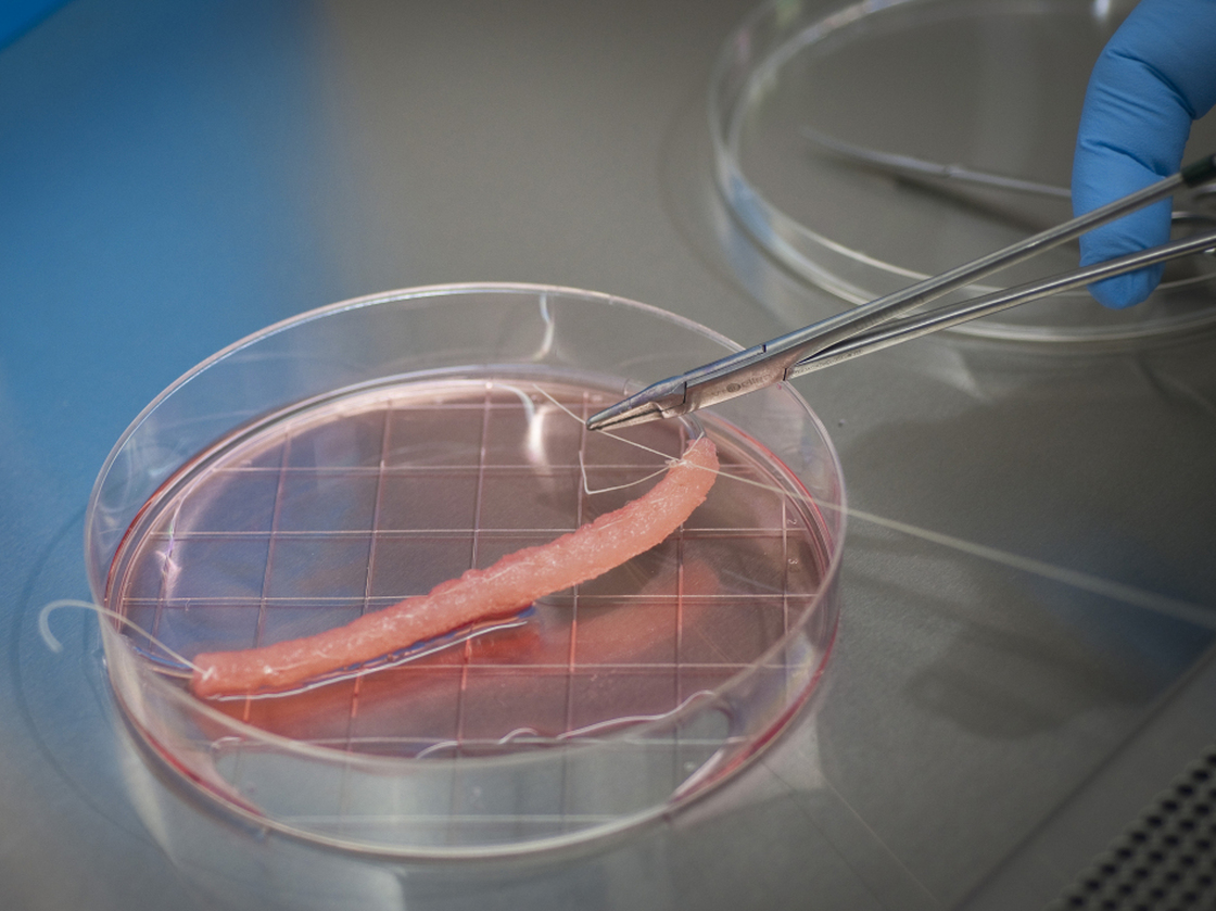 Scientists use a mesh material as a scaffold to seed bladder cells  as they grow. After three to six weeks, the cells are transplanted inside the child's urethra, where they eventually replace the damaged tissue.