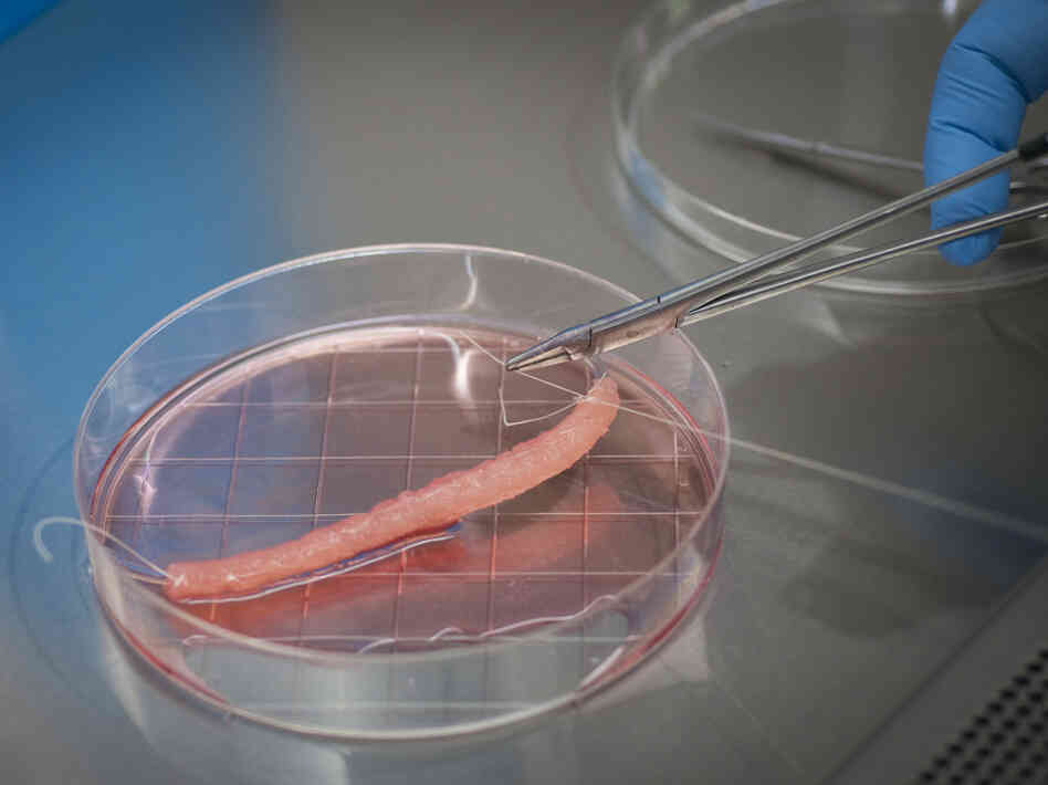 Scientists use a mesh material as a scaffold to seed bladder cells  as they grow. After three to six weeks, the cells are transplanted inside the child's urethra, where they eventually replace the damaged tissue.