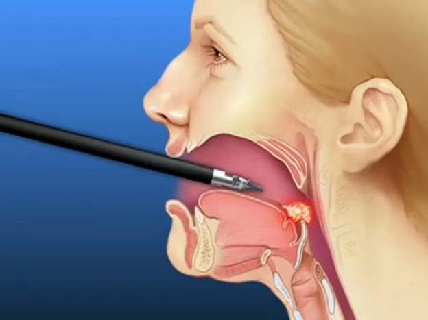 Doctors are treating sleep apnea with a type of robotic surgery typically used to remove cancerous tumors at the back  of the throat.