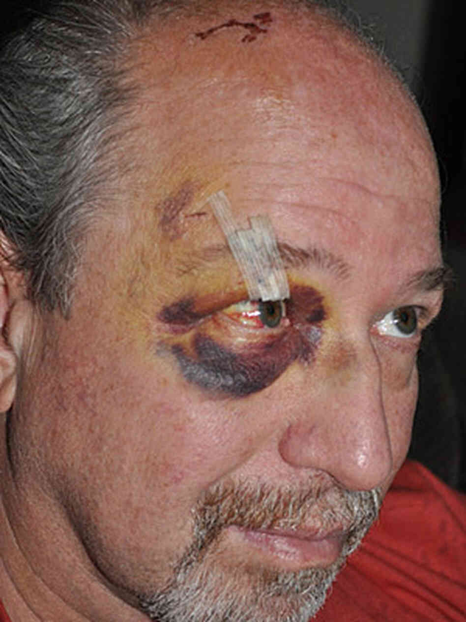 Dr. Richard Frishman, a psychiatrist at Napa State Hospital, photographed after he was attacked by a patient. Dr. Richard Frishman, a psychiatrist at Napa State Hospital, photographed after he was attacked by a patient.
