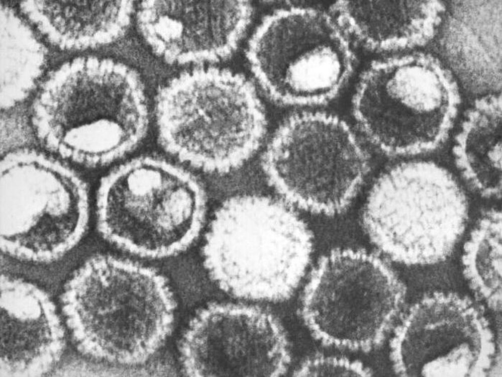 Herpes simplex virus can spread even when symptoms are absent.