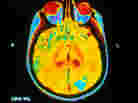 Brain MRI with Cancerous Tumor Brain MRI with Cancerous Tumor